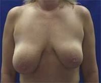 Uneven Breasts 